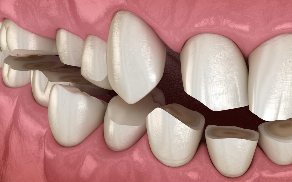 bruxismo cause e cura