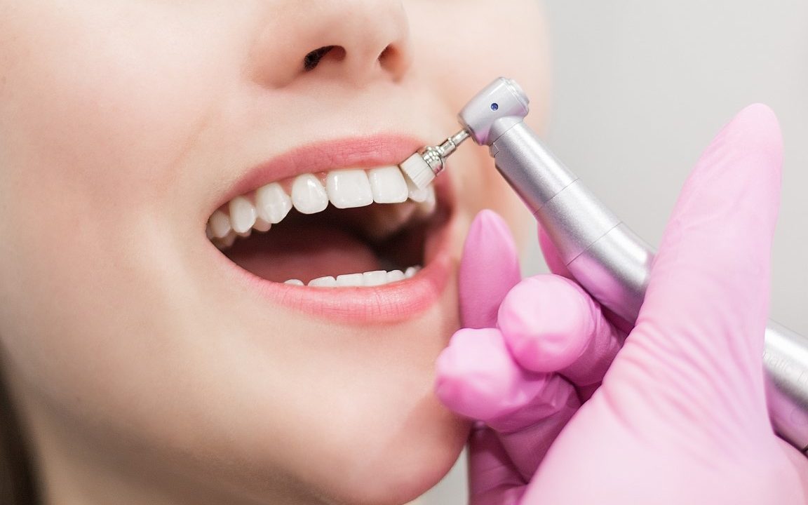 pulizia denti torino