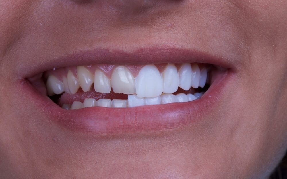 faccette dentali
